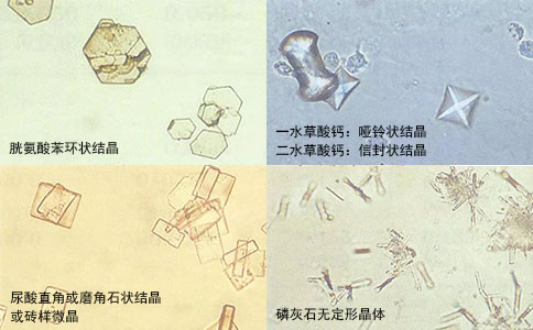 钬激光腔内碎石