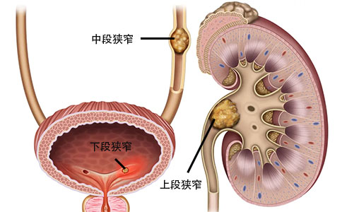 肾结石