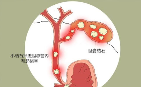 肝胆结石碎石机,体内冲击波胆道液电碎石仪,肝胆微创碎石术