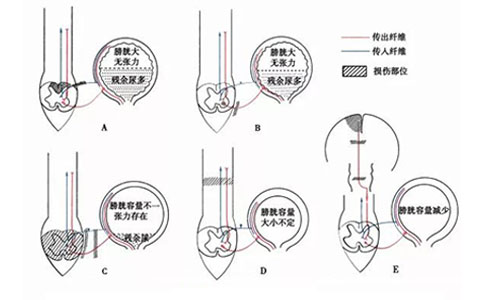 尿动力学评估、排尿障碍