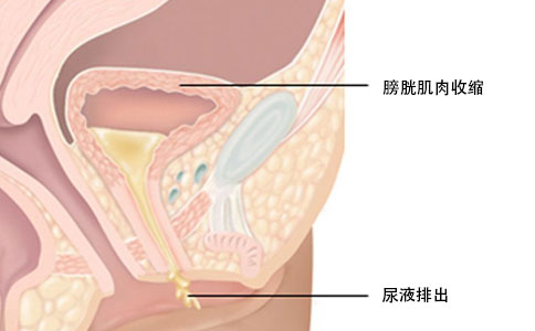 尿动力学检查