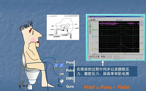 尿动力学检查