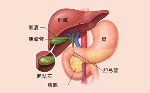 胆结石治疗