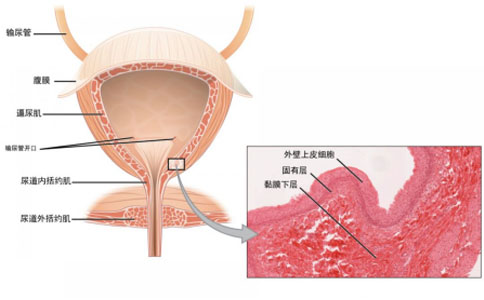 不稳定膀胱