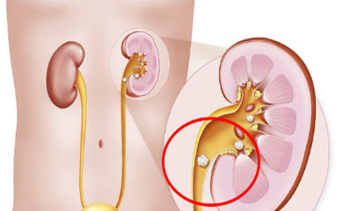 肾下盏结石