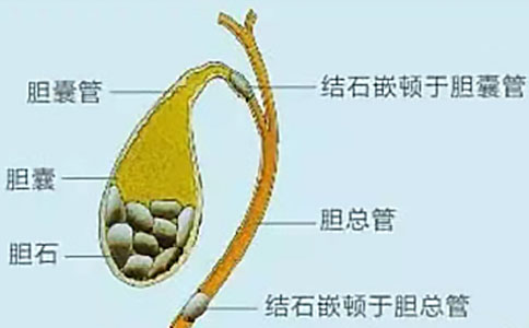 胆结石