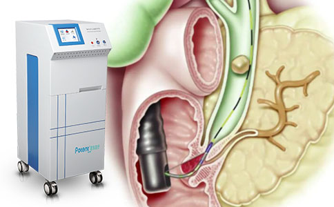 体内冲击波碎石取石术