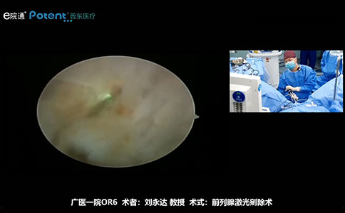 经尿道120W钬激光前列腺剜除术