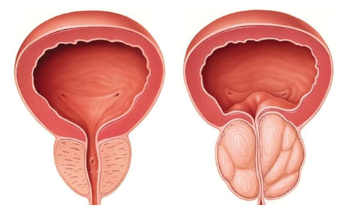 前列腺增生