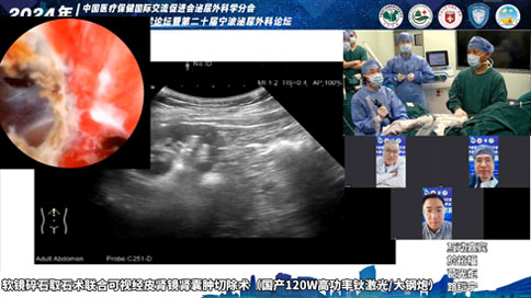 软镜碎石取石术联合可视经皮肾镜肾囊肿切除术（国产120W高功率钬激光/大钢炮）