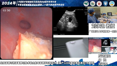 经皮肾镜可视肾囊肿切除术联合航母肾镜碎石取石术（国产120W高功率钬激光/大钢炮）