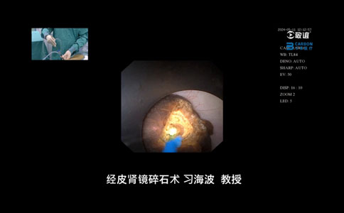 大钢炮经皮肾镜碎石术