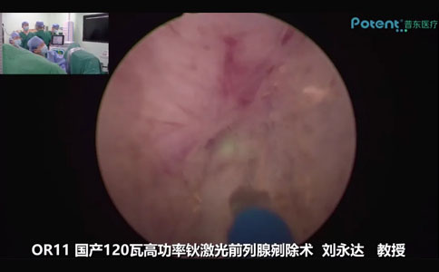 国产120W高功率钬激光前列腺剜除术