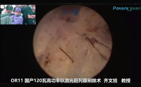 国产高功率钬激光前列腺剜除术
