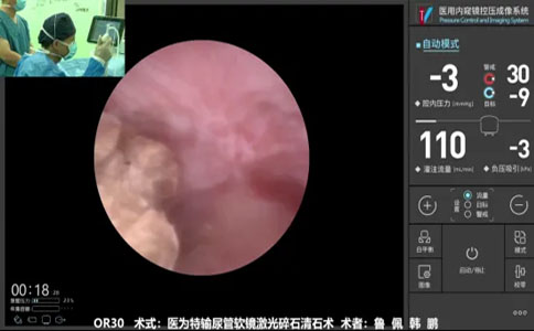 输尿管软镜碎石清石术