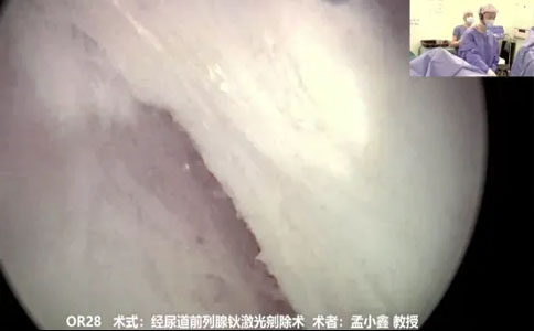经尿道前列腺钬激光剜除术
