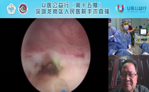 经尿道剜切术