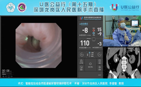 输尿管软镜碎石取石术