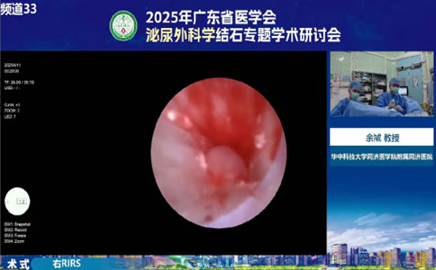 高功率钬激光右RIRS