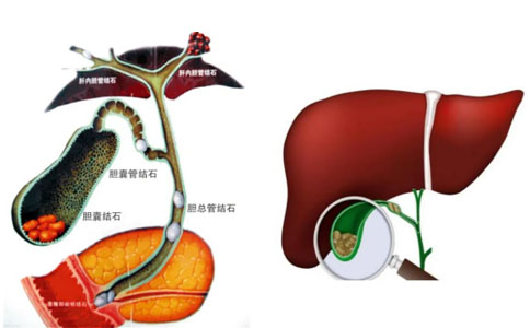 肝胆结石激光