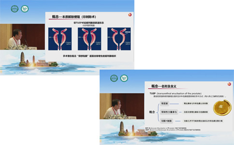 经尿道前列腺剜除术