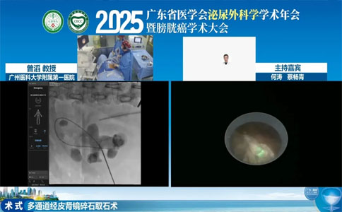 高功率钬激光碎石