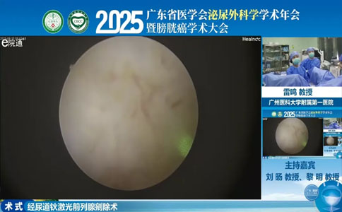高功率钬激光剜除