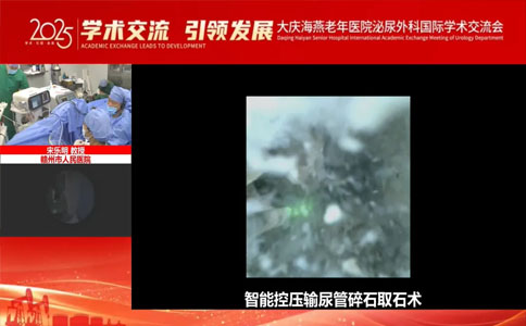 高功率钬激光结石手术