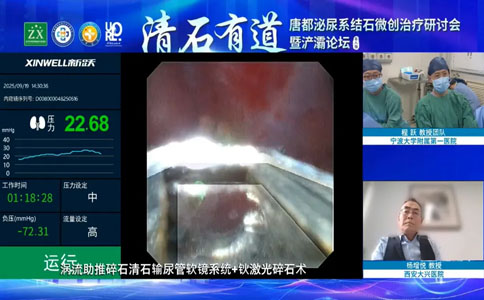 结石微创治疗