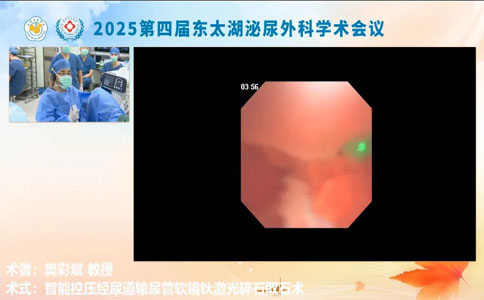 软镜钬激光碎石