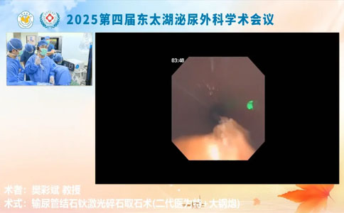 输尿管结石钬激光