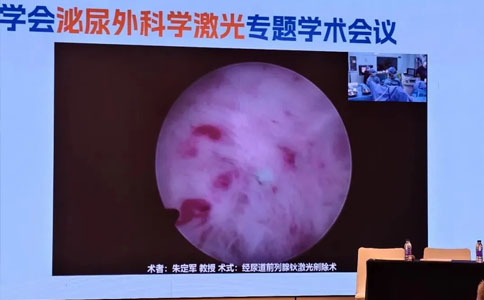 钬激光剜除